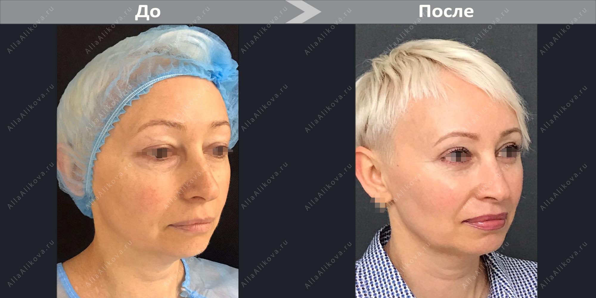 элина дагаева фото до и после операции