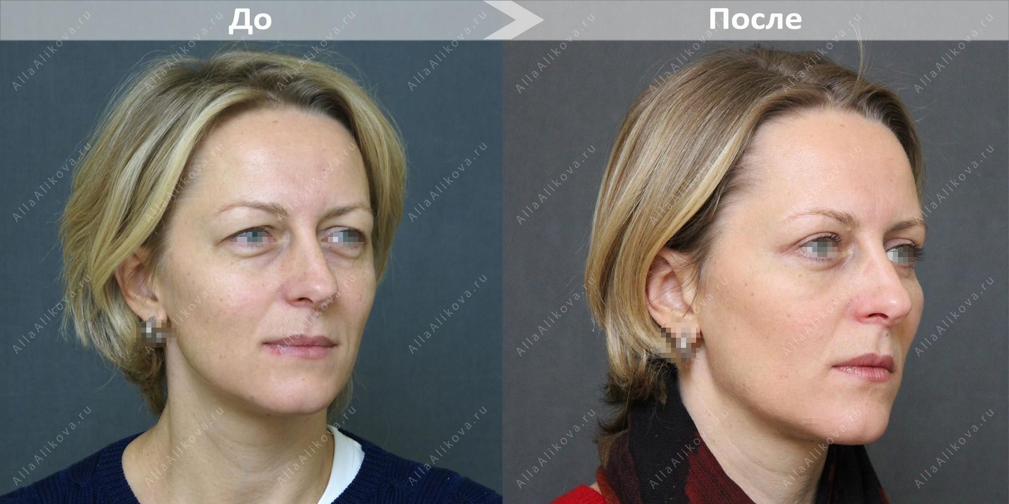 Яковлева до и после блефаропластики