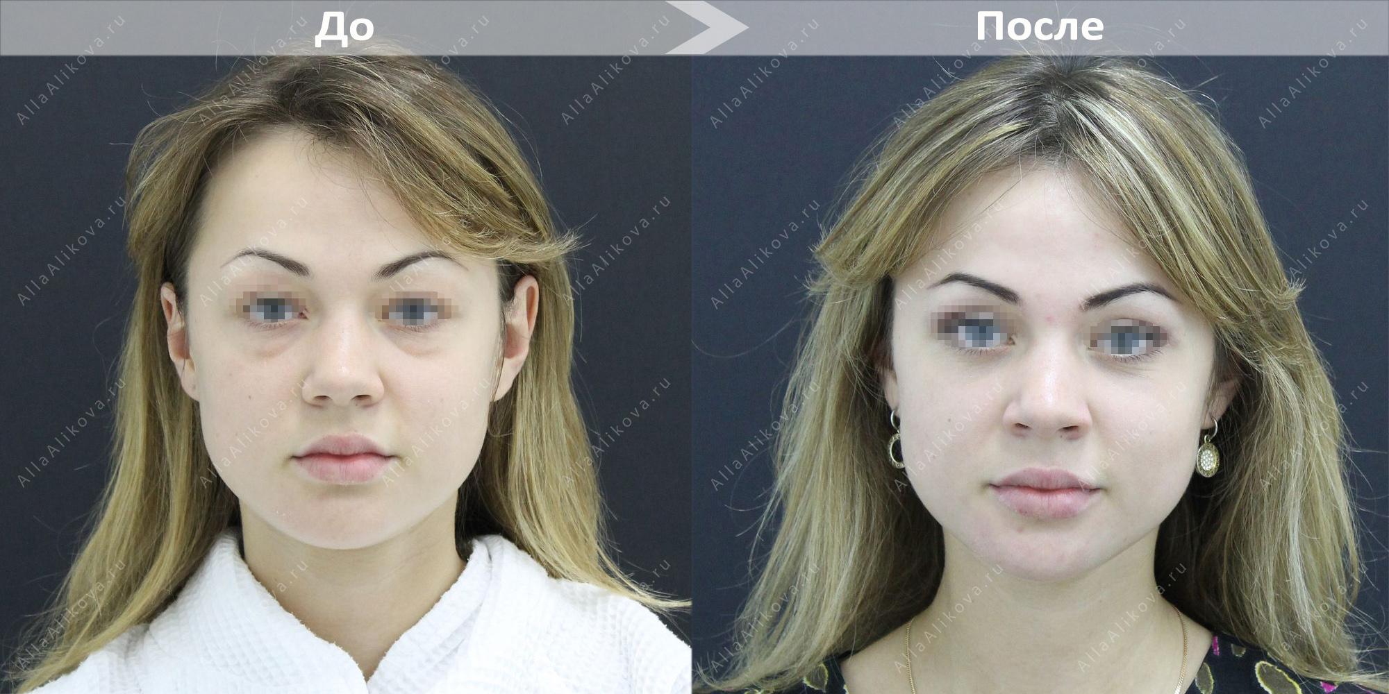 верхняя блефаропластика до и после фото женщины