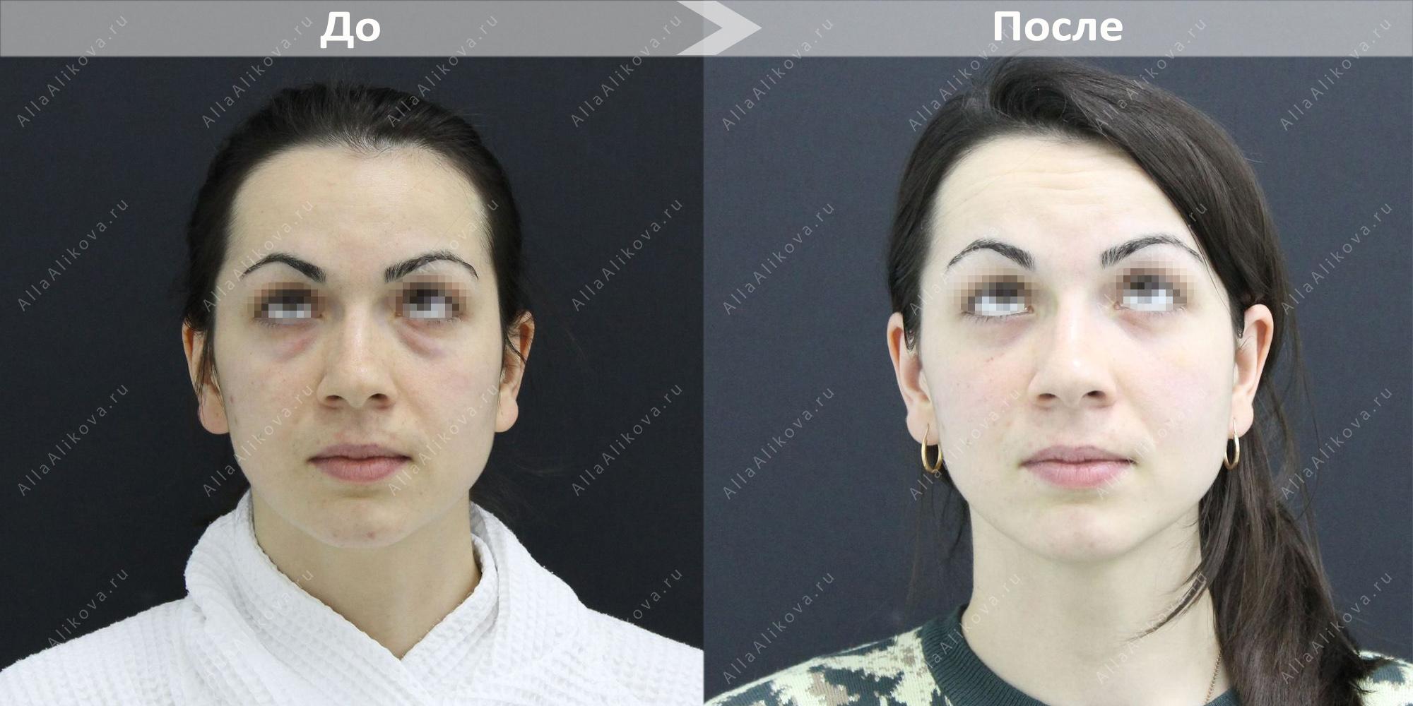 Трансконъюнктивальная нижняя блефаропластика фото до и после