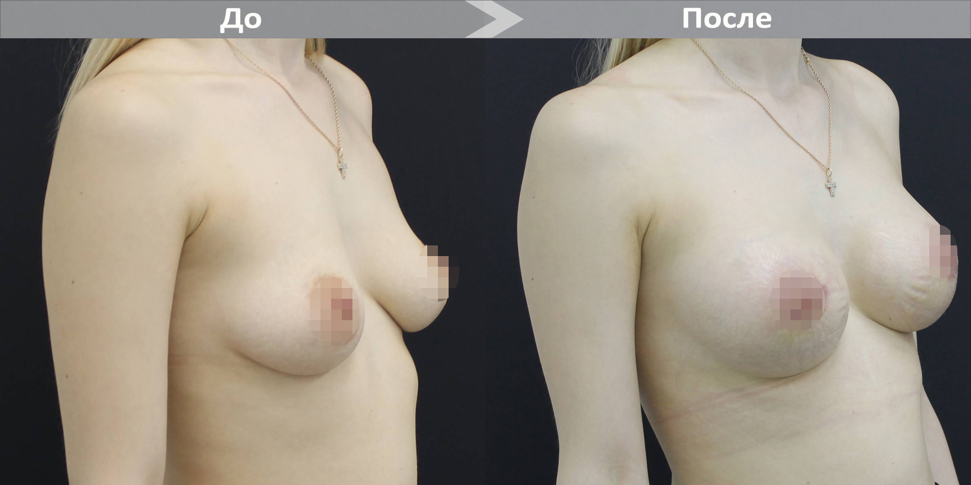 удаление и восстановление груди в одну операцию фото 79