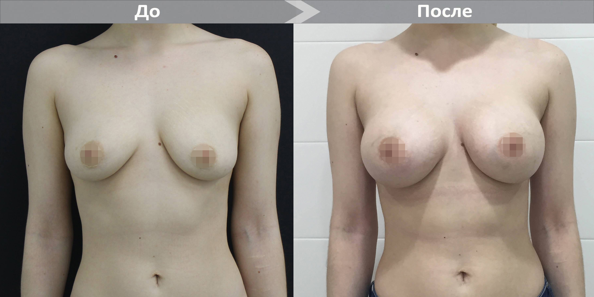как делают пластическую операцию груди женщин фото 83