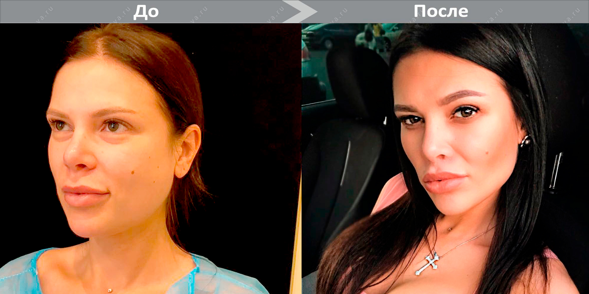 элина дагаева фото до и после операции